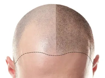 Hair Tattoos | Proven Bald Head Solution | The Scalp Clinic